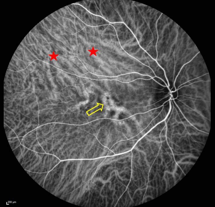 Figure 2. Angiographie au vert d’indocyanine d’un patient présentant une CRSC chronique bilatérale. Notez l’asymétrie supérieure du drainage veineux choroïdien – étoiles rouges au niveau du territoire de la vortiqueuse temporale supérieure qui est dominant par rapport à celui de la temporale inférieure. Des pachyvaisseaux choroïdiens traversent la macula (flèche jaune).
