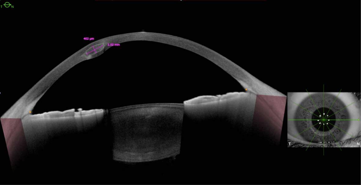 Figure 1. Tomographie cornéenne par cohérence optique : le CAIRS est placé à 50% – et non à 80% comme pour les ICRS – de l’épaisseur cornéenne et mesure 402 μm d’épaisseur in vivo.
