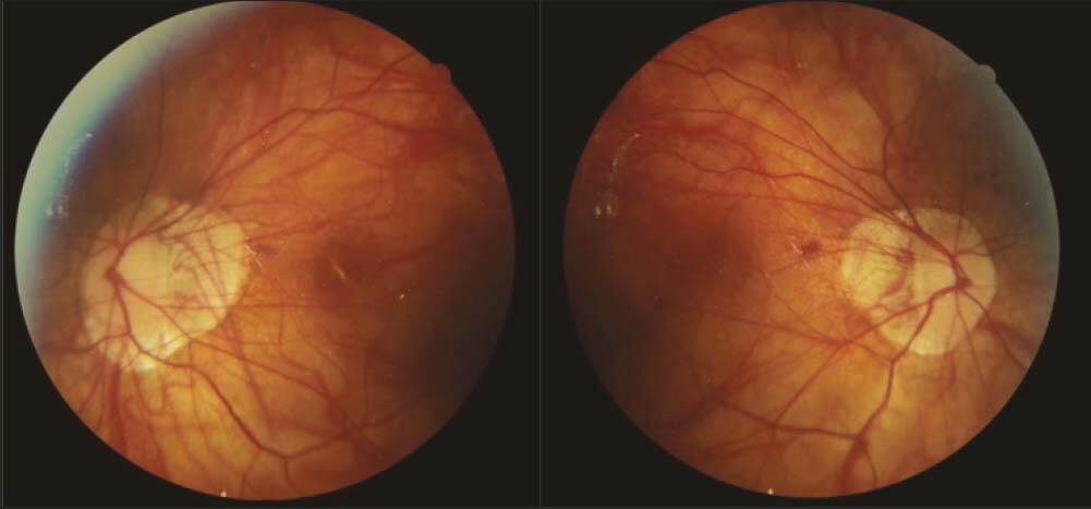 Figure 1. Rétinophotos d’un patient myope fort présentant un glaucome traité par bithérapie. On note l’aspect dysversique des nerfs optiques qui présentent une large atrophie péripapillaire des 2 côtés. On note également l’atrophie choriorétinienne diffuse. 
