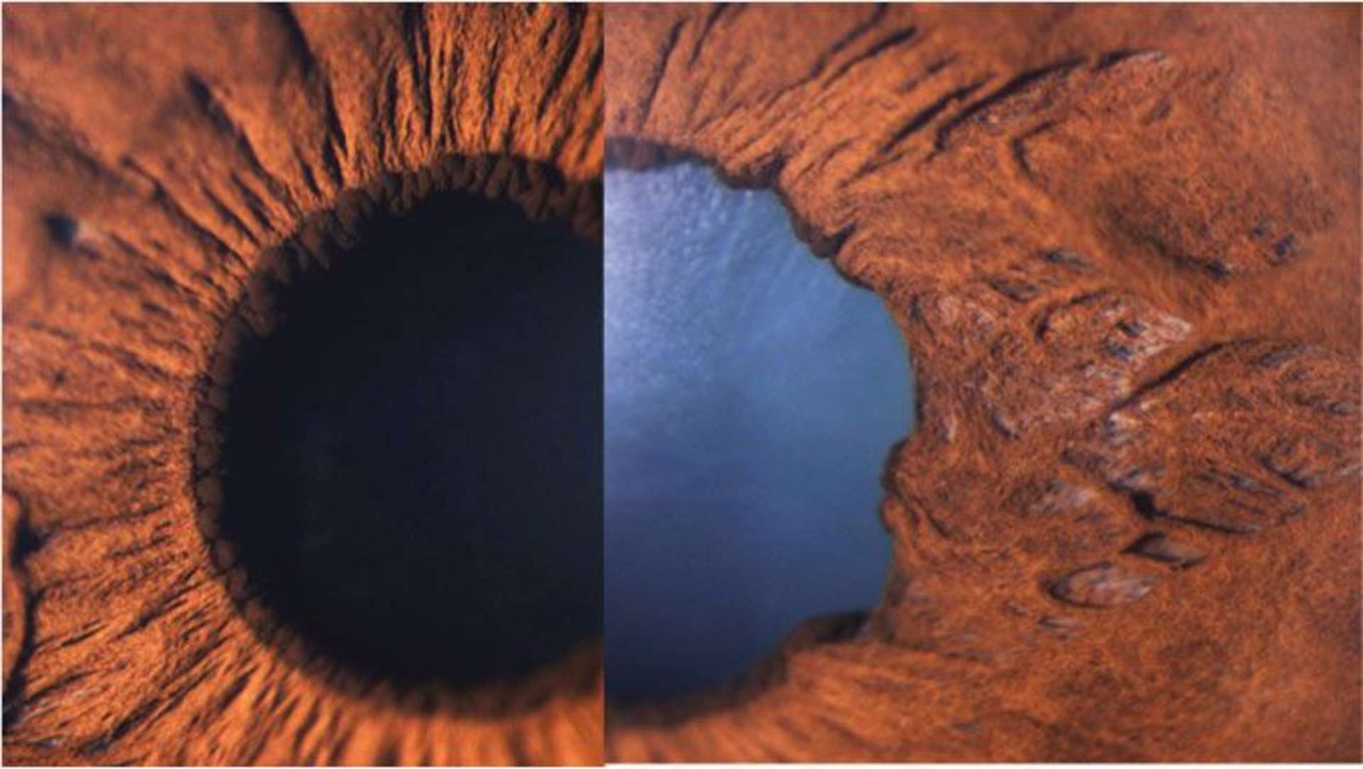 A gauhe : œil adelphe. A droite : Rupture du sphincter irien : en myosis, il existe une anisocorie et une disparition du plissement de la marge pupillaire.
